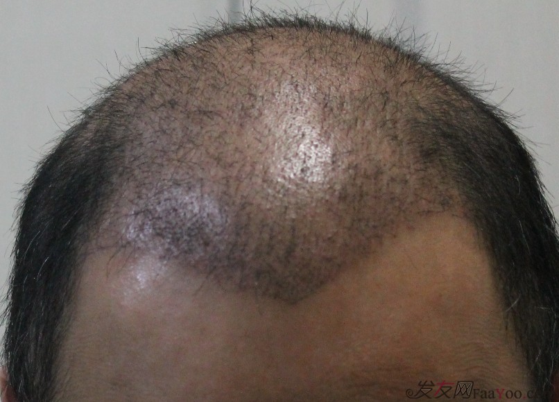 上海四一一植发医院植发一般每单位多少钱?效