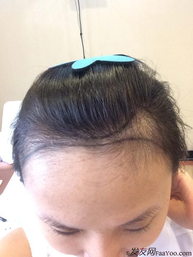 致力于<em>头发</em>时尚与健康|关于美发_植发_脱发_假