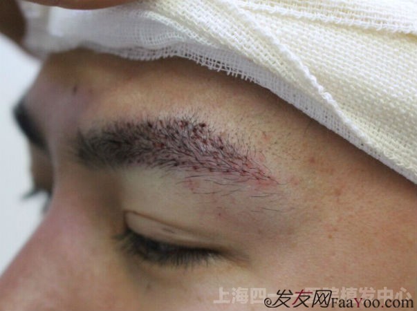 南京男性植发新生植发价格优惠.htm新消息评论