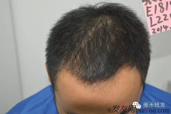 天生头发稀少怎么变浓密 头发稀少怎么变浓密