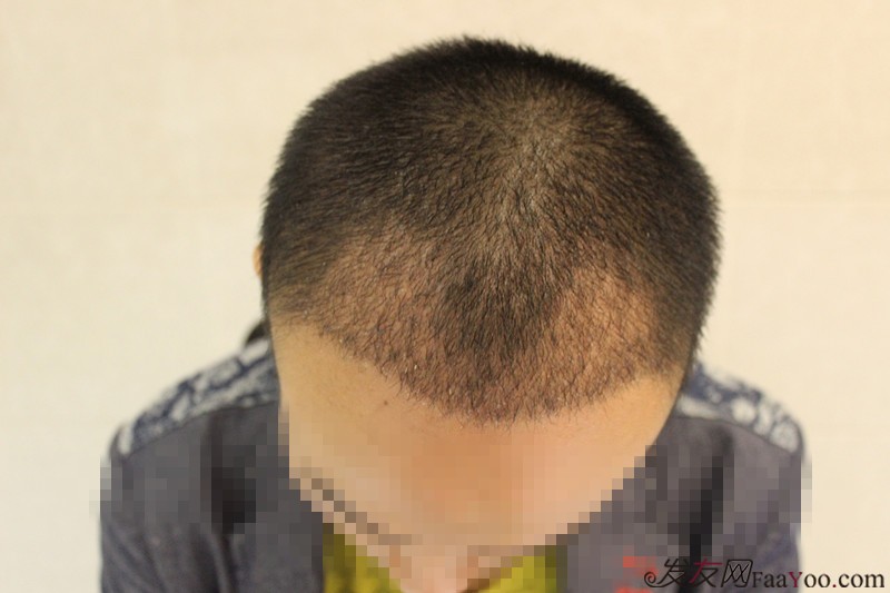 南京男士植发价格新生植发价格低.htm新消息评