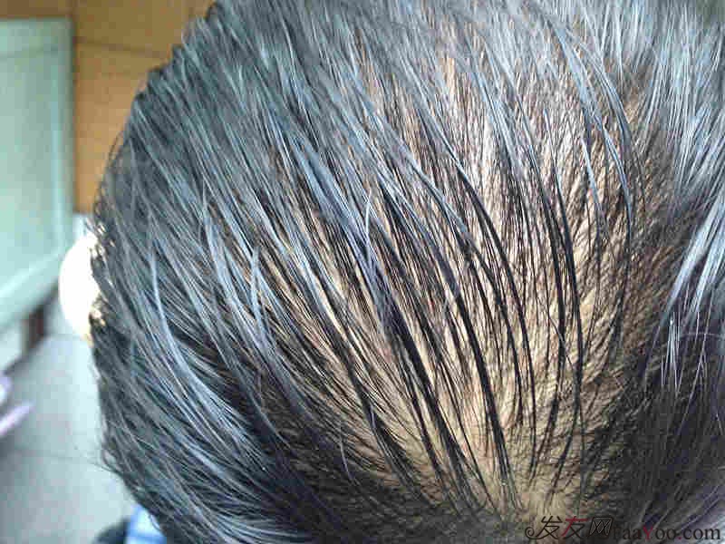 致力于头发时尚与健康|关于美发_植发_脱发_假发_织发补发_最大的交流平台_发友网