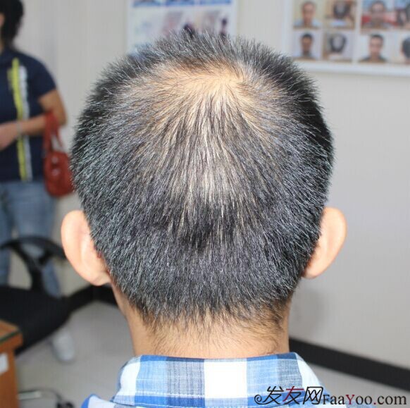 2015年11月16日植发,3000单位,持续更新