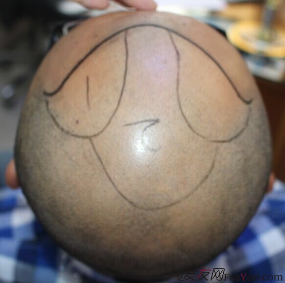 2015年11月16日植发,3000单位,持续更新