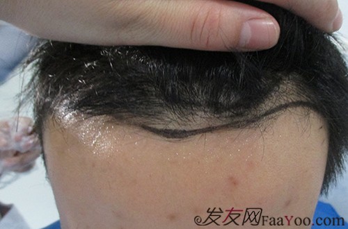 上海四一一植发医院头发种植每单位多少钱?效