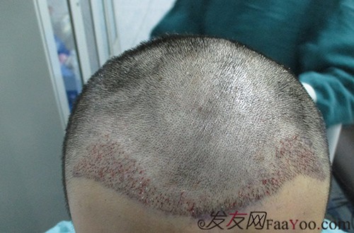 苏州植发医院 发际线种植1500毛囊单位