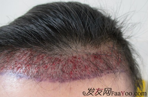 去北京植发,2000毛囊单位多少钱?