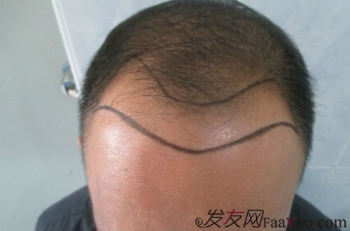 苏州种植发际线 3000单位 成功经历