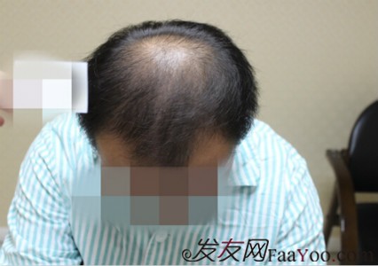 为了耐情, 瑞丽诗植发3000单位 - 植发论坛 - Fa