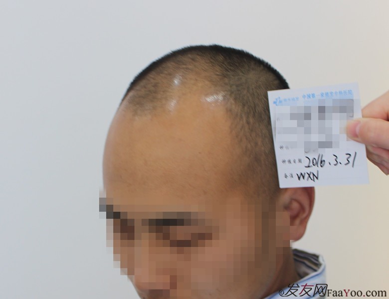 郑州雍禾植发,3200单位,当兵也不容易,探亲假来