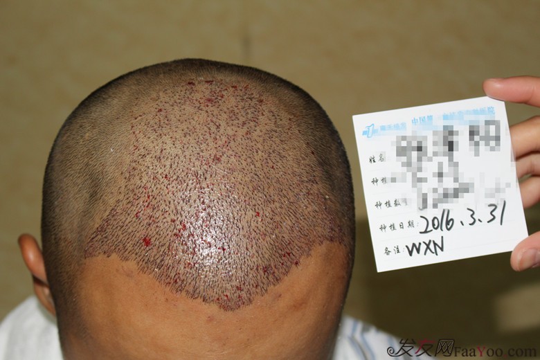 郑州雍禾植发,3200单位,当兵也不容易,探亲假来