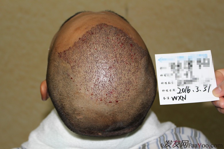 郑州雍禾植发,3200单位,当兵也不容易,探亲假来