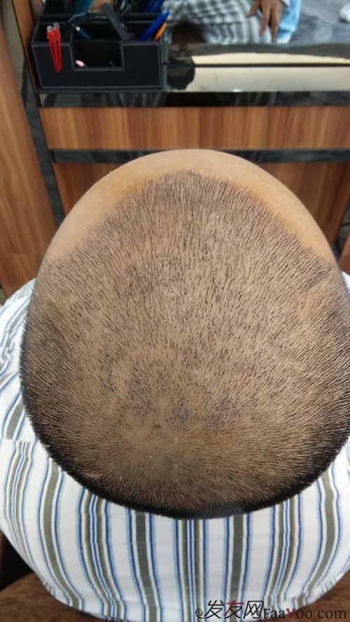 郑州雍禾植发,3200单位,当兵也不容易,探亲假来