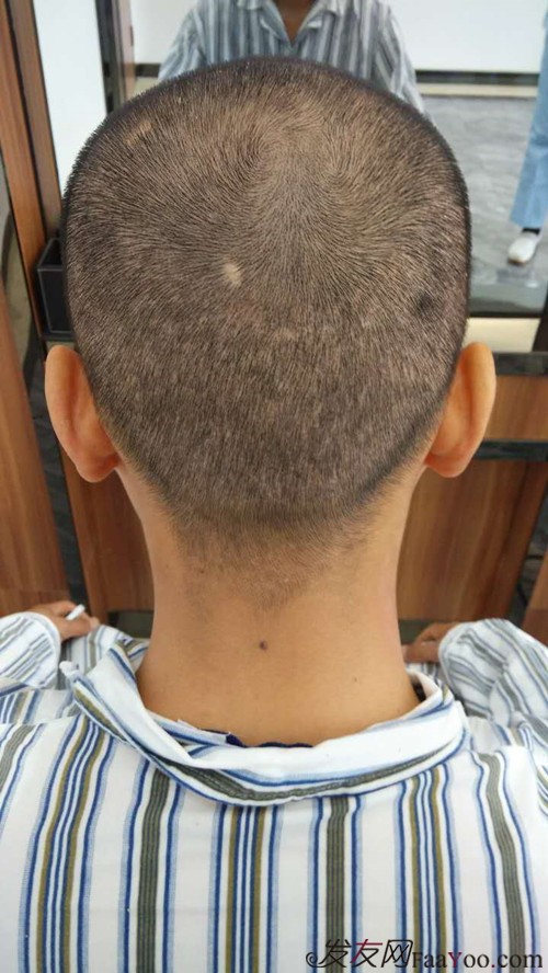 郑州雍禾植发,3200单位,当兵也不容易,探亲假来