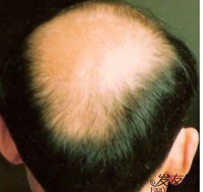 雄激素脱发原因及治疗方法都有哪些，雄激素脱发怎么回事 