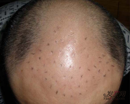 如何正确的选择植发,什么症状的脱发适合做植