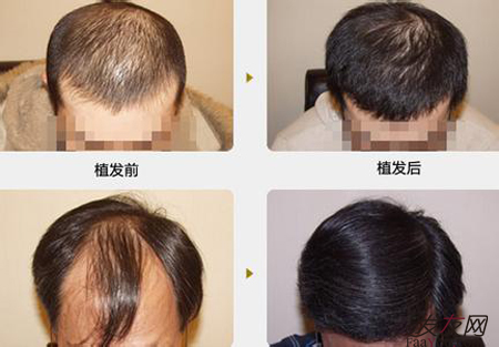 种植头发到底好不好,头发种植有危险吗?_发友