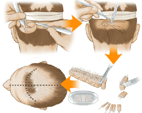 植发靠谱吗,植发手术真的能解决脱发问题吗?_