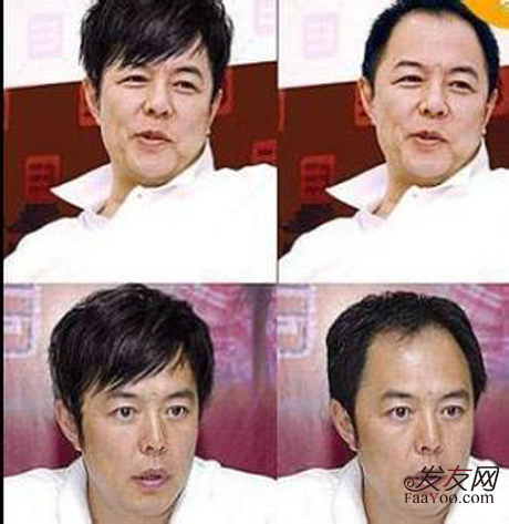 植头发贵吗,现在植头发需要多少钱?_发友网