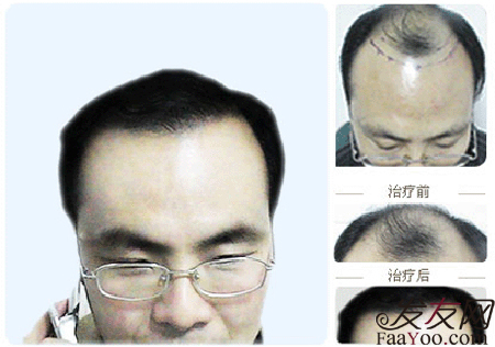 北京植头发多少钱,北京哪家医院植头发效果好