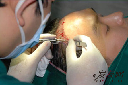 植<em>头发</em>手术价格受什么因素影响<em>比较</em>大?_发友