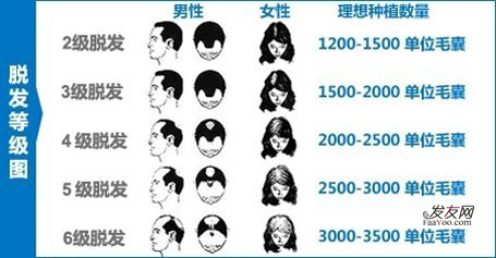 北京植发医院的植发价格是如何计算的?_发友