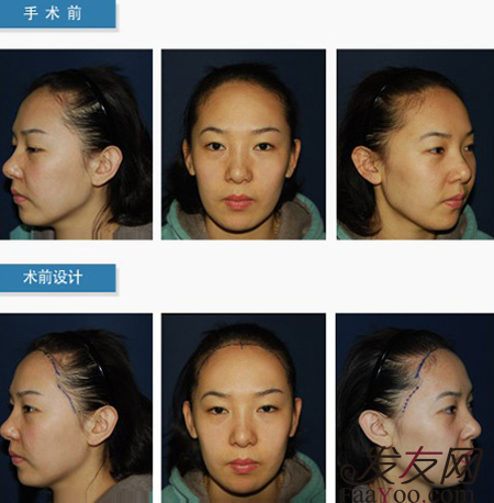 <em>女性</em>额头高做<em>植发</em>手术<em>好不好</em>,和男性<em>植发</em>一样