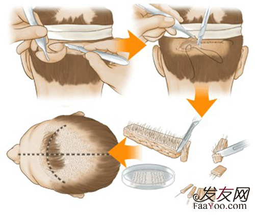 上海哪里植头发好?_发友网
