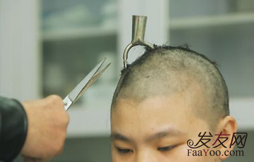 植发手术后过了狂脱期,头发没长这种现象正常