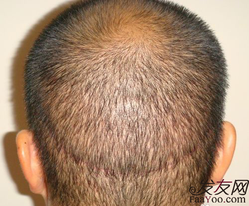 脂溢性脱发怎么治疗，最为有效的方法是什么？