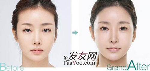 女性植发效果不如男性,这是为什么呢?_发友网