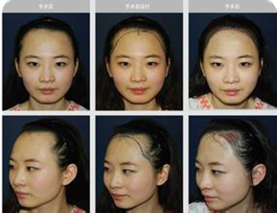 成都空军机关医院植发怎么样,植发价格才是王