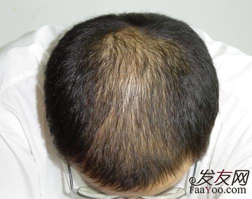 王宇讲解：治疗脱发都有什么方法？　