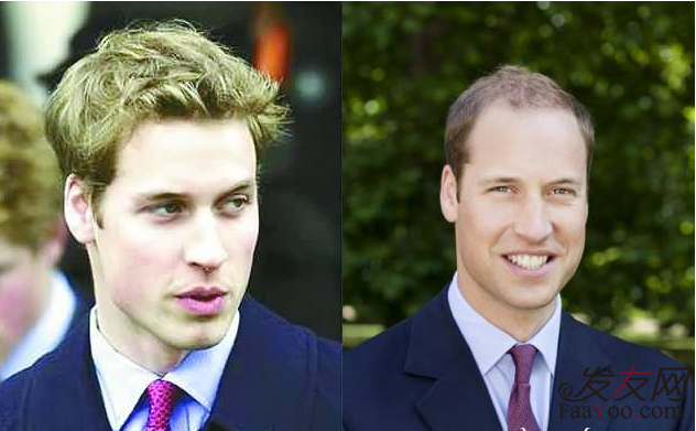 威廉王子遗传性脱发