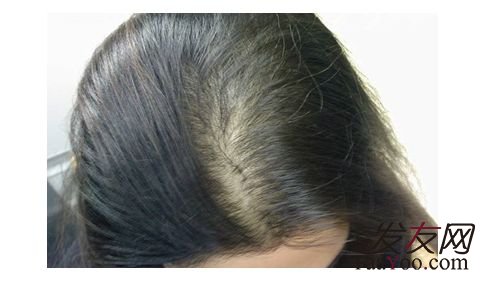 女性头发稀少治疗