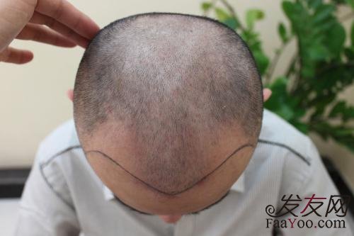 男性脱发是“绝症”吗？