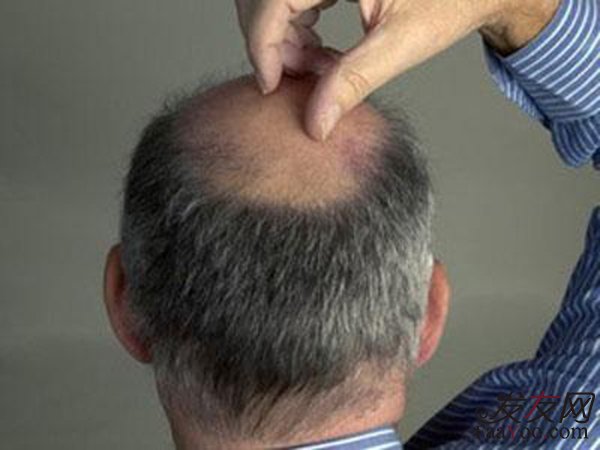 脱发比较常见的几种的治疗方法