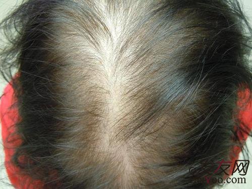 脂溢性脱发怎样才能治好？