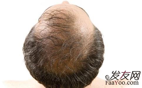 男性脱发了还可以治疗好吗？