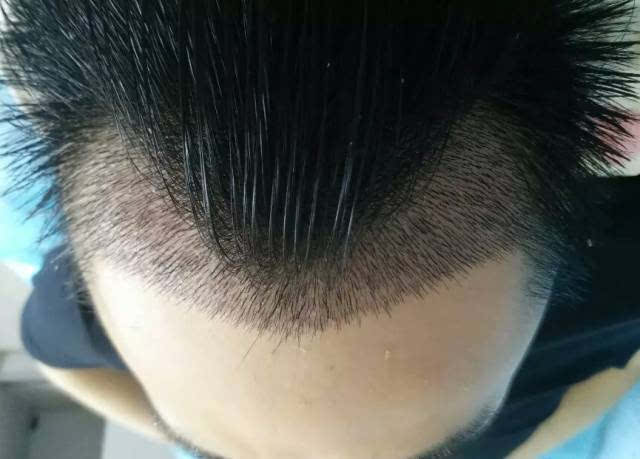 男性脱发可以彻底根治吗？