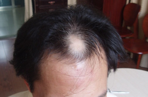 遗传性脱发是怎么回事图片1