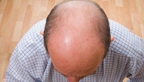 导致脂溢性脱发的原因都有哪些呢？文章图片2