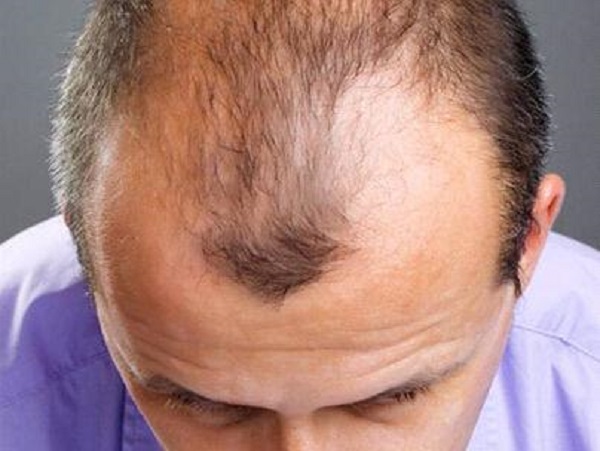 年轻男性碰到脂溢性脱发应该要怎么办