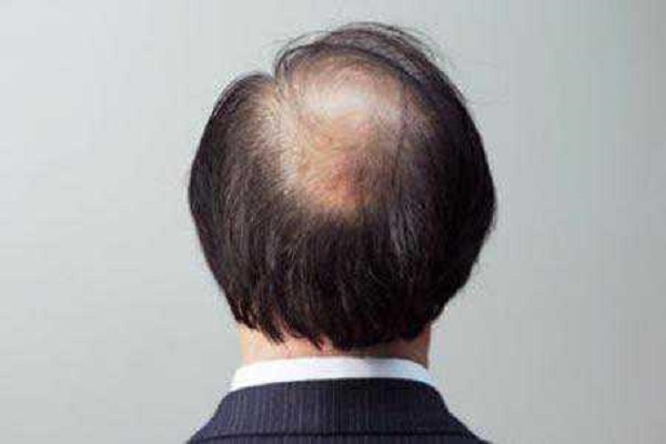 遗传性脱发最常发生于什么年龄段