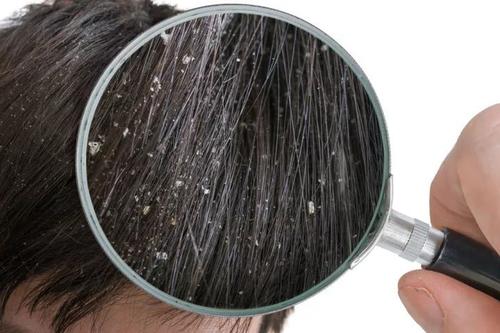 脂溢性皮炎会导致脱发吗