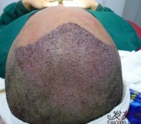 关于FUT头发种植技术知识简介