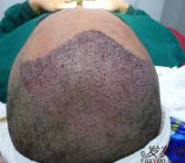 关于FUT头发种植技术知识简介