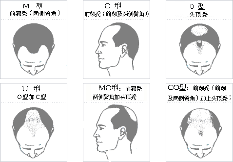 前额脱发是如何形成的,如何解决前额脱发问题