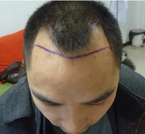 什么是O型脱发,O型脱发形成原因有哪些?