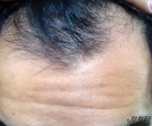 油脂性脱发是怎么回事，如何治疗油脂性脱发